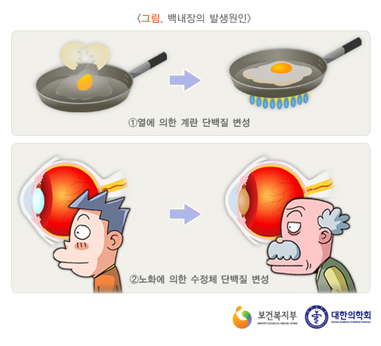 라식, 라섹, 백내장 후 케어 블루라이트 차단 안경 필수!